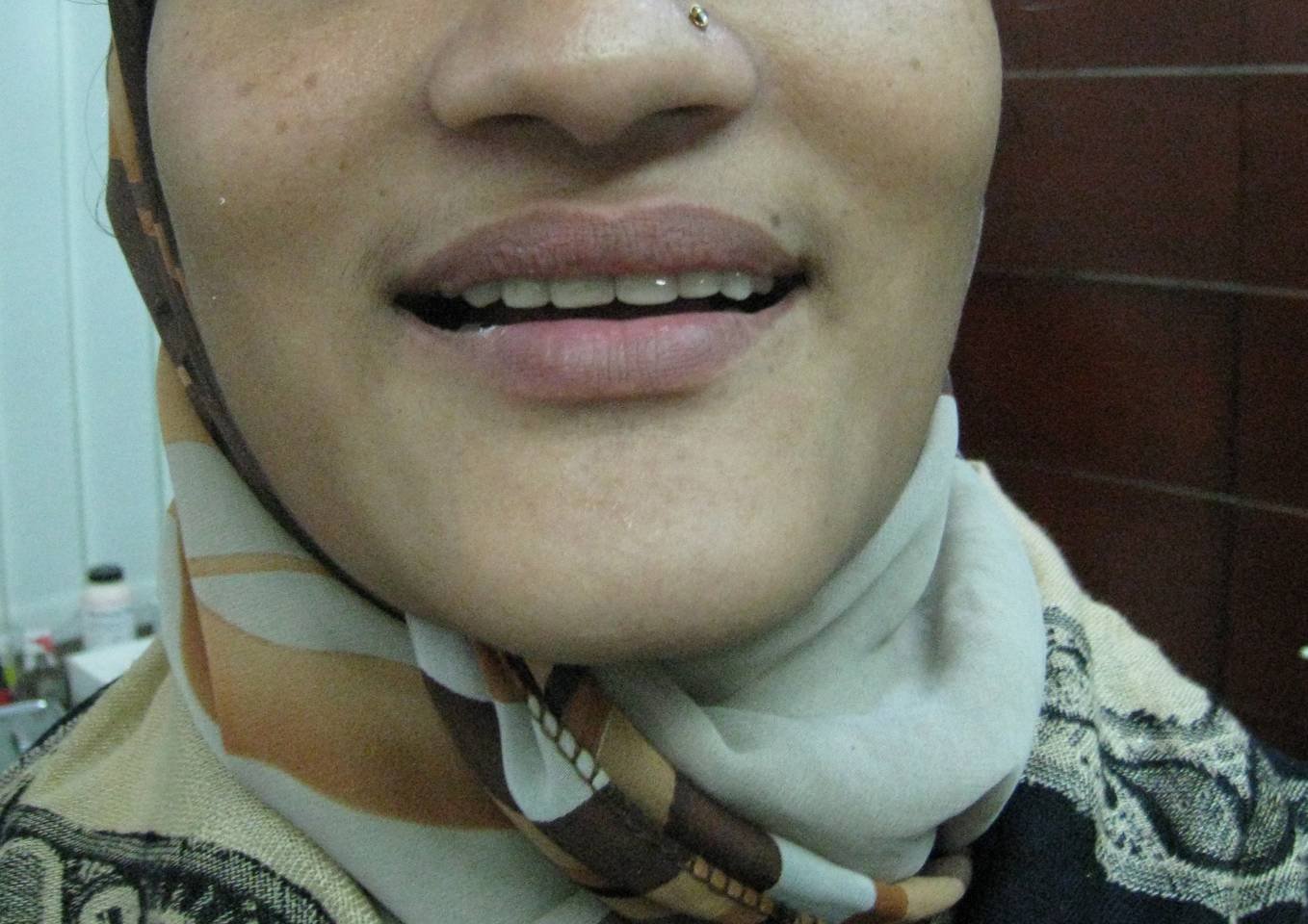 Gapped Teeth After - Patient 2