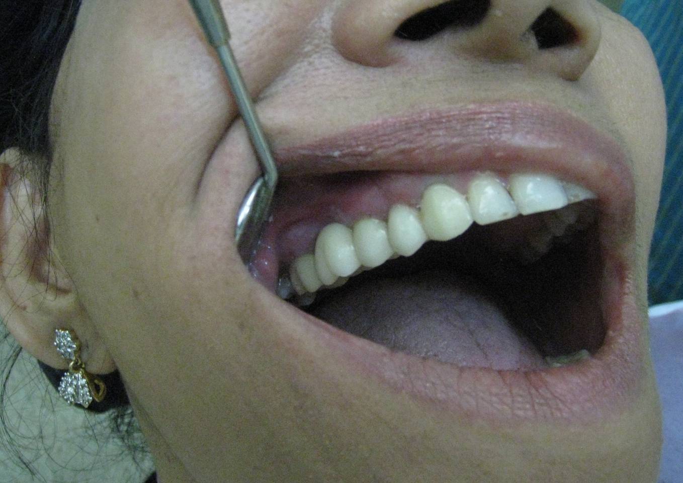 Gapped Teeth After - Patient 7