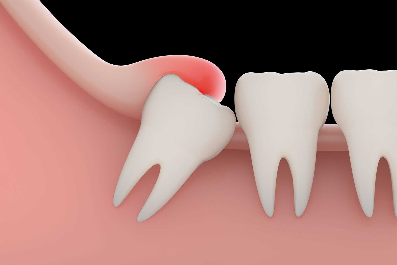 Guide to Wisdom Teeth Extraction