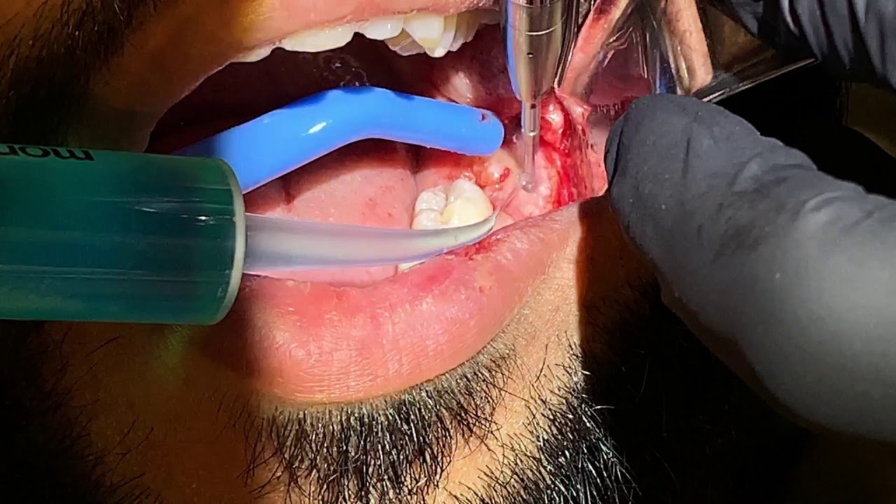 How to Prepare for Oral Surgery for Impacted Teeth