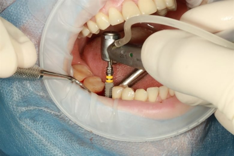 Dental Implants Surgery